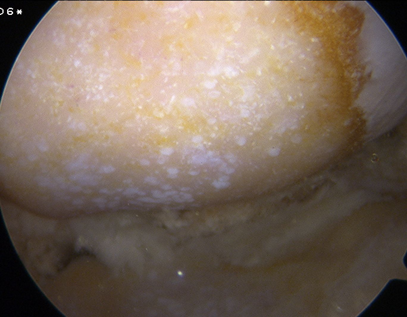 Knee Arthroscopy Chondrocalcinosis
